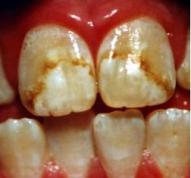 fluorosis-dental